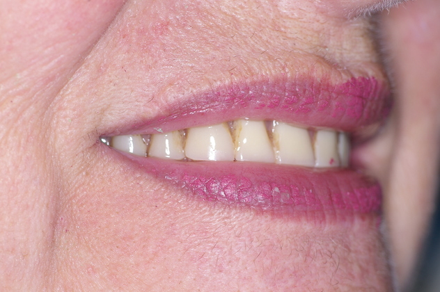 before new dentures