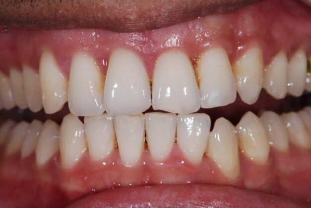 Clear Aligners After