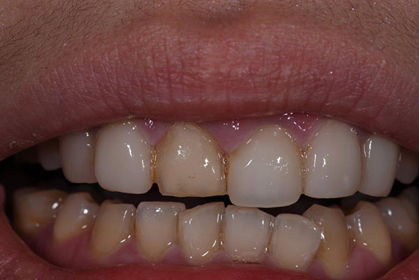 custom veneers composite