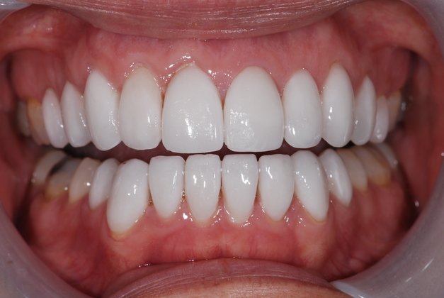 porcelain veneers after photo