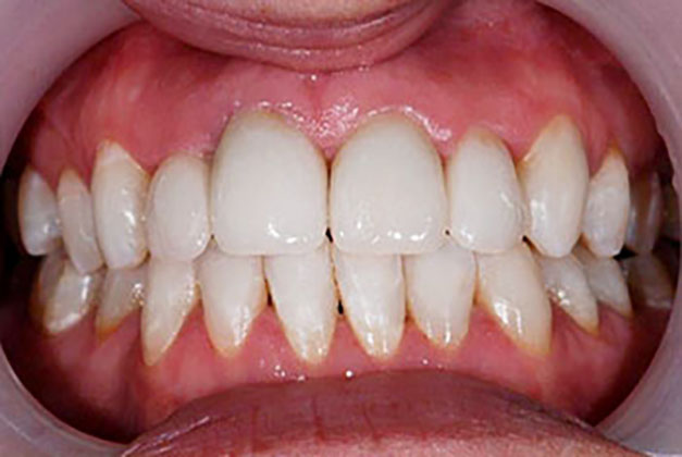 Porcelain Veneers After Photo 2