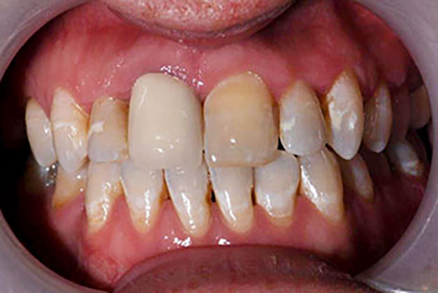 porcelain veneers before photo 2