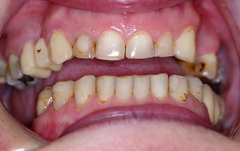 before dental reconstruction
